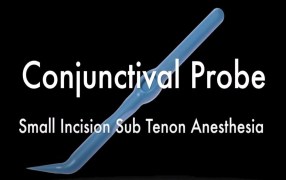 Small Incision Sub Tenon Anaesthesia (SISTA)